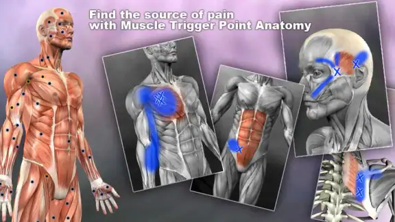 Muscle Trigger Point Anatomy screenshot