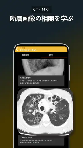 胸部X線 | 学ぶ胸X screenshot